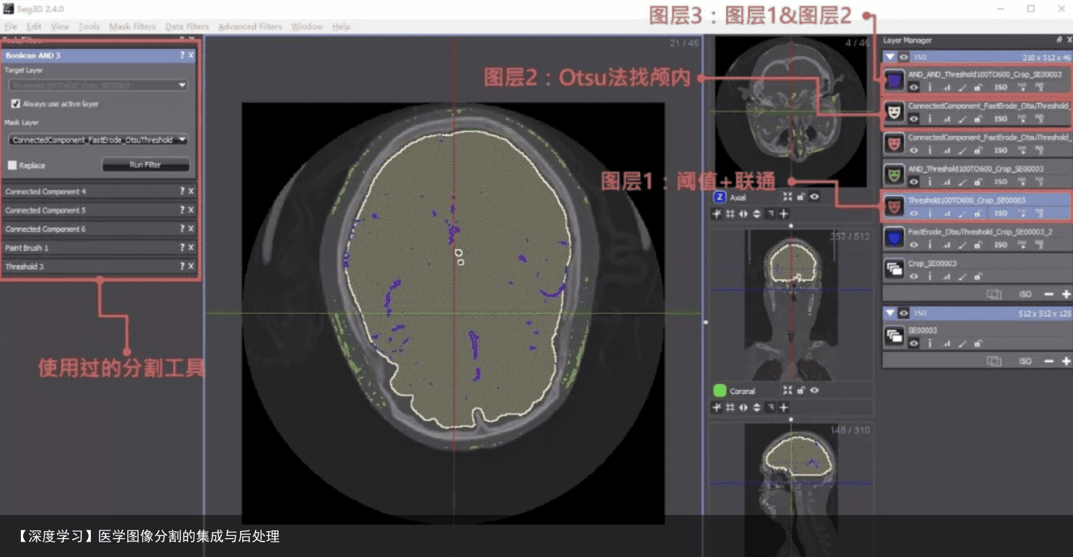 【深度学习】医学图像分割的集成与后处理