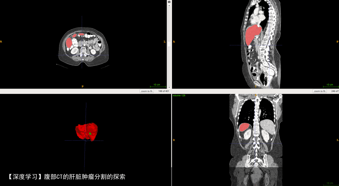 【深度学习】腹部CT的肝脏肿瘤分割的探索3
