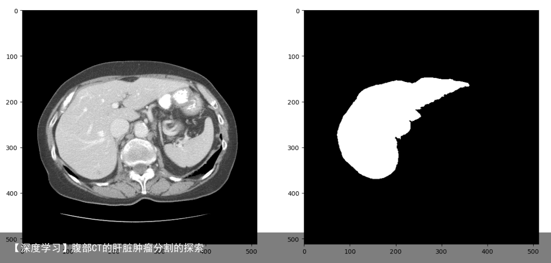 【深度学习】腹部CT的肝脏肿瘤分割的探索8