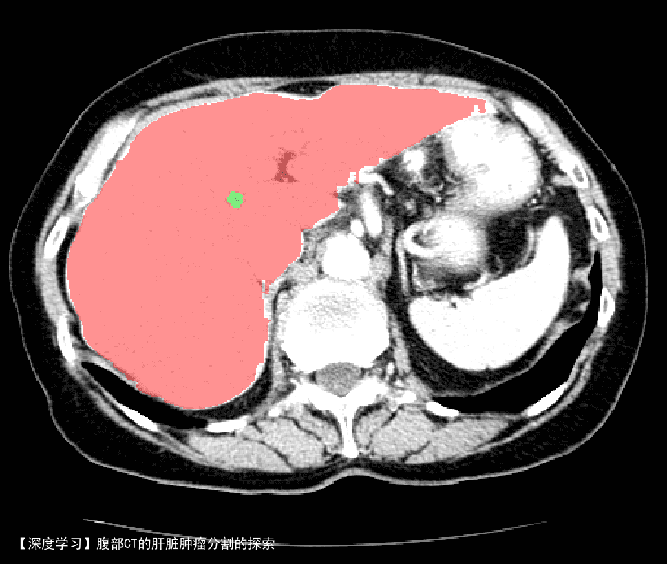 【深度学习】腹部CT的肝脏肿瘤分割的探索10