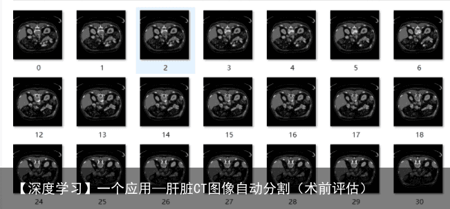 【深度学习】一个应用—肝脏CT图像自动分割（术前评估）
