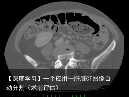 【深度学习】一个应用—肝脏CT图像自动分割（术前评估）2