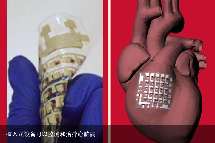 植入式设备可以监测和治疗心脏病
