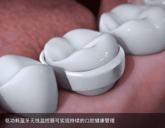 低功耗蓝牙无线监控器可实现持续的口腔健康管理2