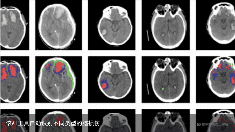 该AI工具自动识别不同类型的脑损伤